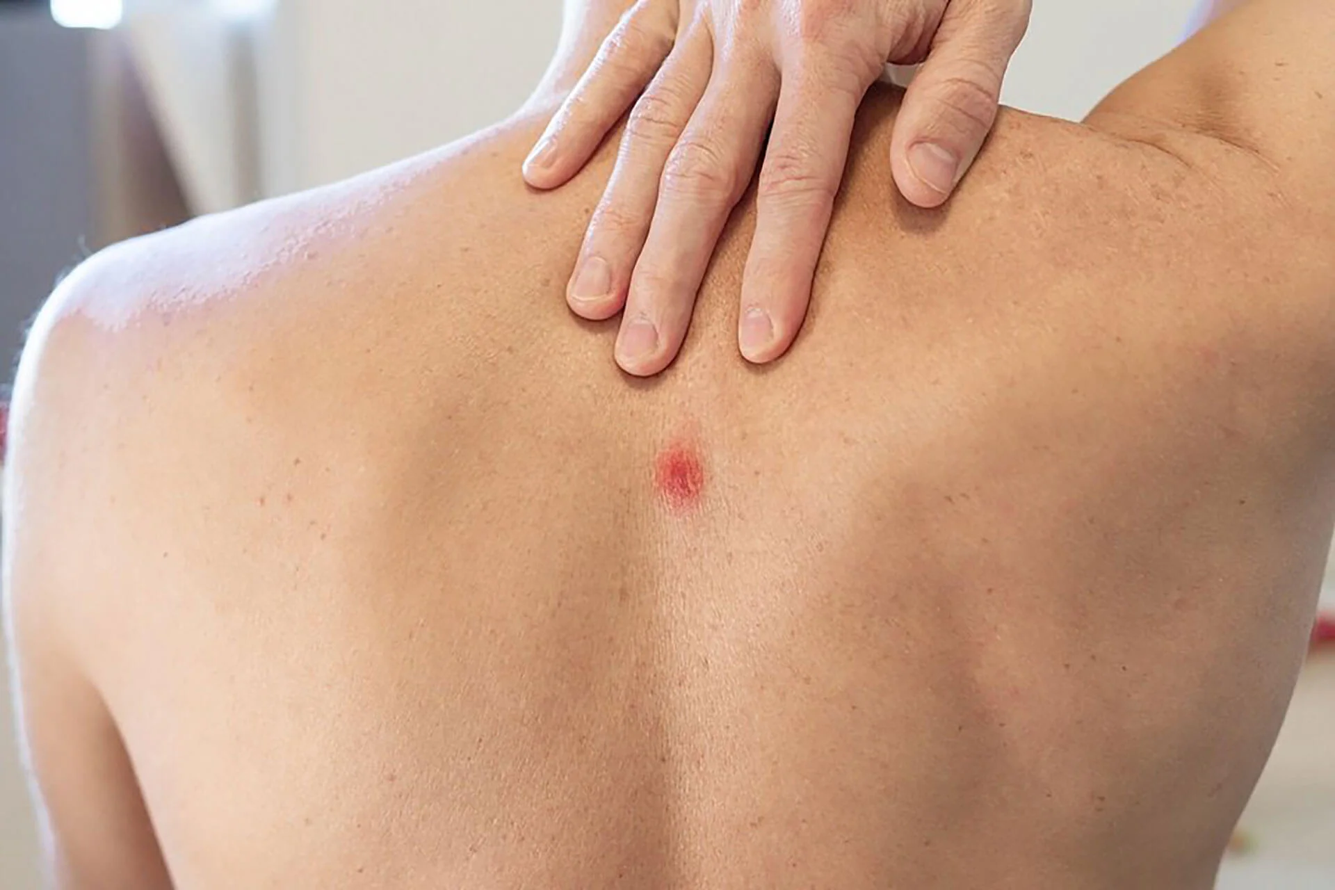 Acute Care Visits 6 65568c1d5806694601f72f1d Abscess Incision and Drainage